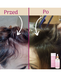 Serum stymulujące na porost włosów po chemioterapii Nachemii 100 ml