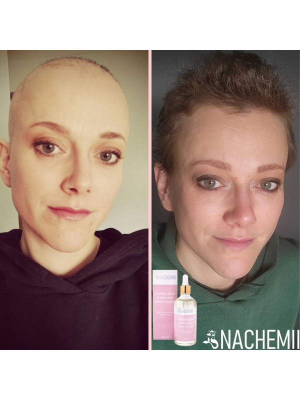 Serum stymulujące na porost włosów po chemioterapii Nachemii 100 ml