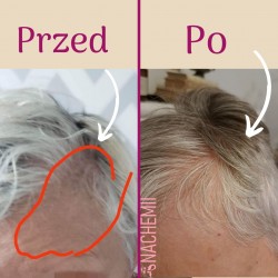 Serum stymulujące na porost włosów po chemioterapii Nachemii 100 ml